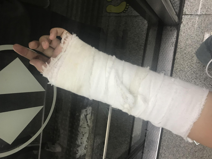 冲突中，乔棋的爸爸用水果刀划伤了她的虎口&nbsp;