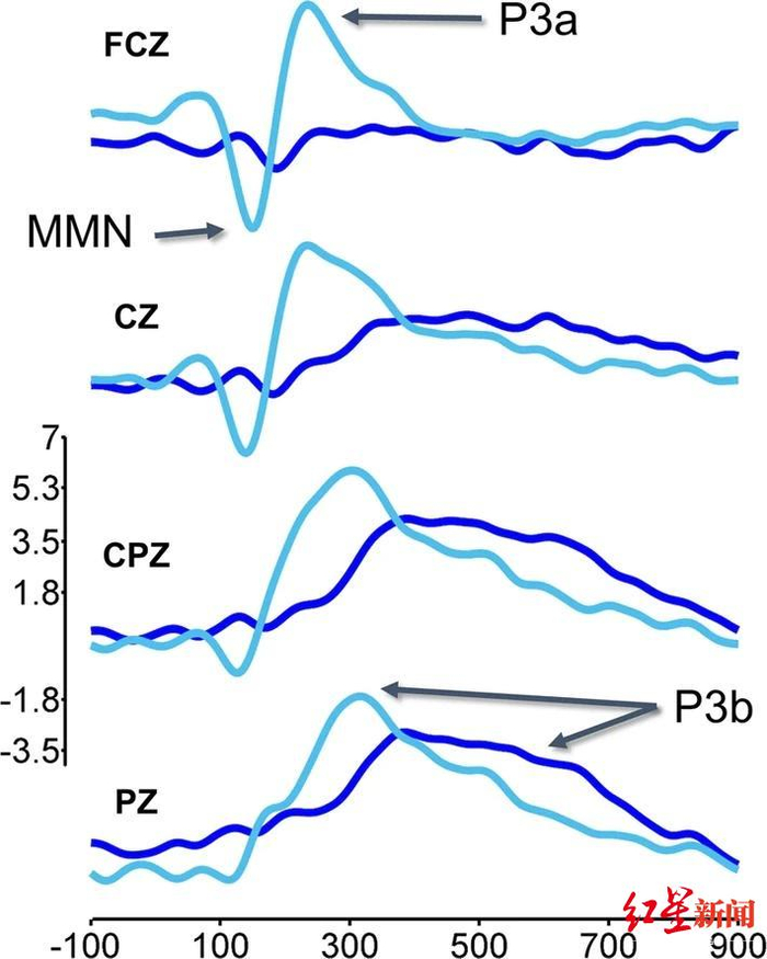 ▲科学家发现的三类大脑活动表明，没有意识的病人正在“听到”音调和模式的变化。图据《科学报道》