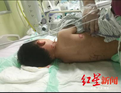 ↑5岁男童小丁被狗咬伤。视频截图