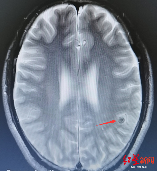 ↑箭头所指处为谭大哥脑内病灶。
