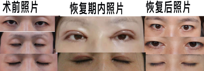 △ 陈宇各时期眼部状态，受访者供图