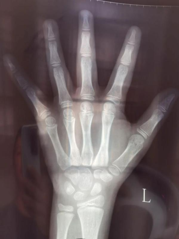 x光骨龄片/图源：受访者