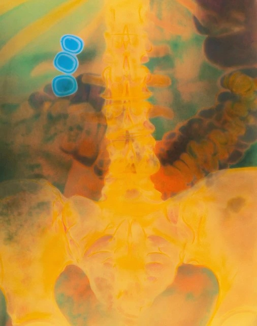 腹部彩色x光片显示胆囊中有胆结石，网络图片，图源：图虫创意