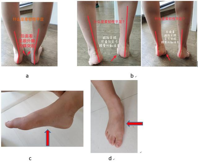 图4：a示孩子站立位从后面视诊，足内侧纵弓消失，足跟外翻，内踝突出，“多址症”；b示 孩子踮足后足弓出现，足跟内翻，内踝突出消失，为柔软性平足；c示 非负重状态有足弓；d示负重位足弓消失