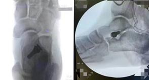 图6：距下关节置入距下制动器后足弓出现