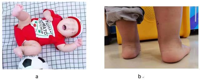 图3：a 4个月婴儿足弓未发育 /b 2岁孩子足弓尚无发育