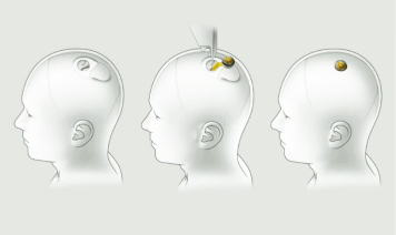 Neuralink brain chip 图源：CNET