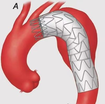 图5：胸主动脉瘤的腔内隔绝治疗