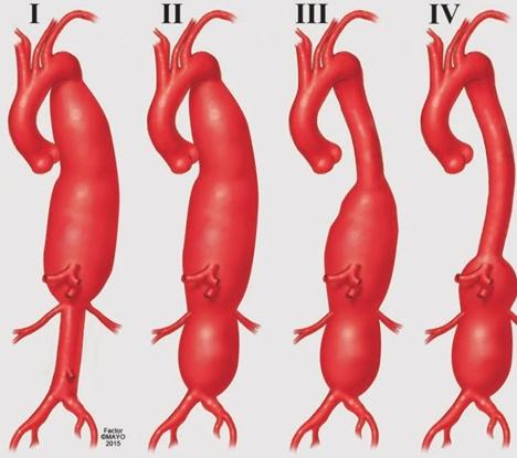 图4：胸腹主动脉瘤分类