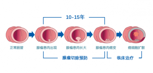 ▲从腺瘤发展到肠癌的过程
