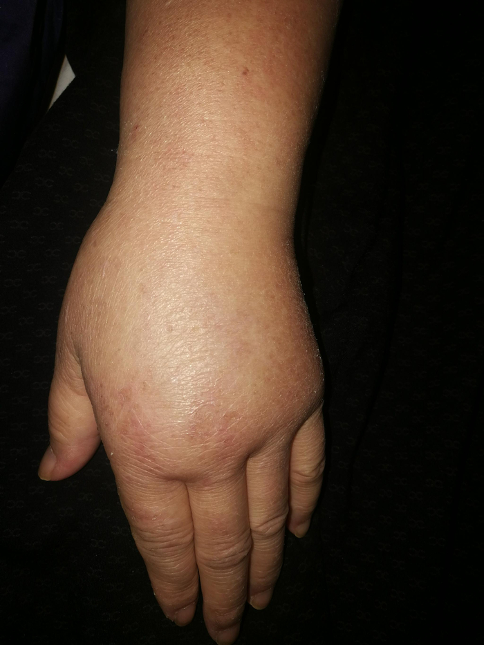  患者表现症状之一