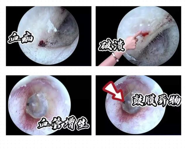 △在内窥镜下，当耳道被放大数倍，可以直观地看到挖耳朵造成的伤害，如血痂、破溃、血管增生、鼓膜异物 。 图源 丨生命时报微信公众号