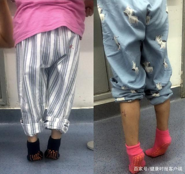 龙凤胎脑瘫兄妹术前的尖足情况（受访者供图）