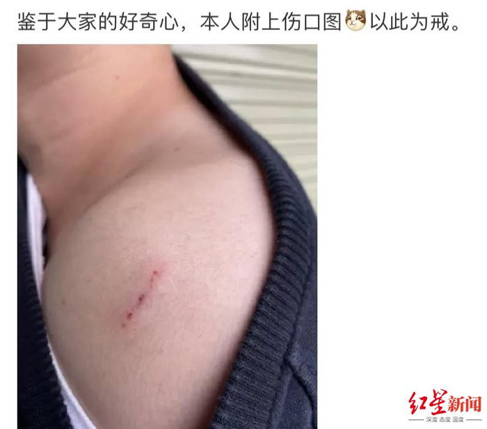  ▲马先生的伤口