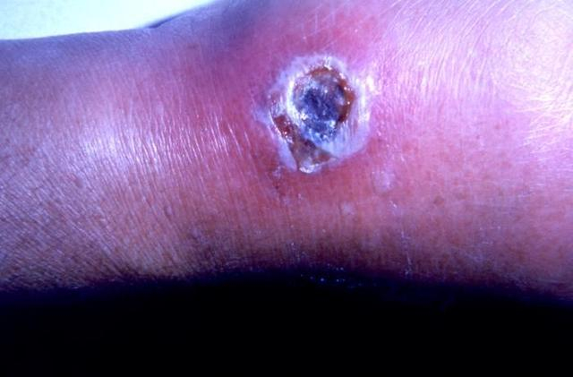 皮肤炭疽感染所引起的病灶，图片来自于网络