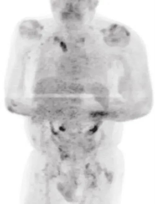 图源：网络，图中所示黑色部分为癌细胞