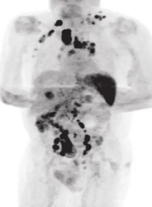 图源：网络，图中所示黑色部分为癌细胞