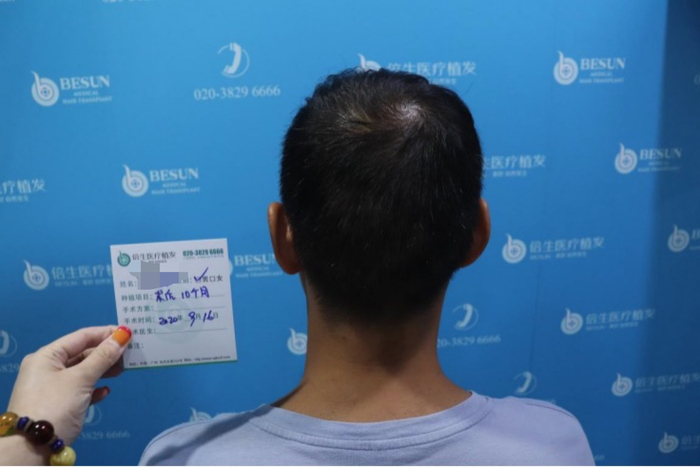 倍生植发拍摄照片。受访者供图