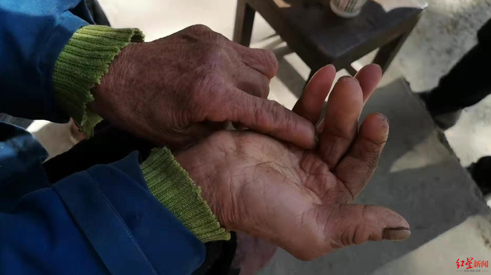 老人的右手已经变形