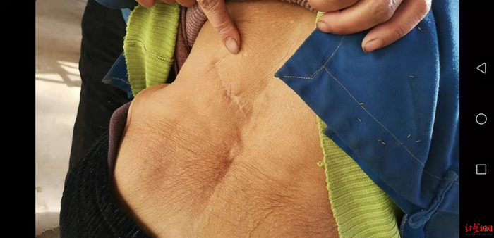 老人腰部的伤疤