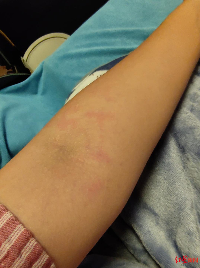 记者手臂出现了红白斑纹，医生诊断为灼伤
