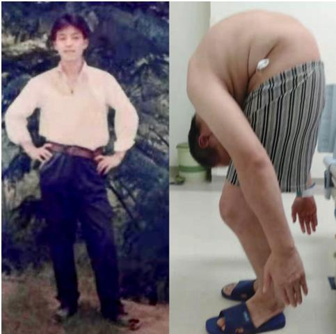 李华生病前后的对比照片。受访者供图