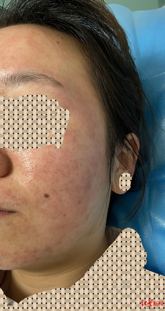 ▲小吴面部。