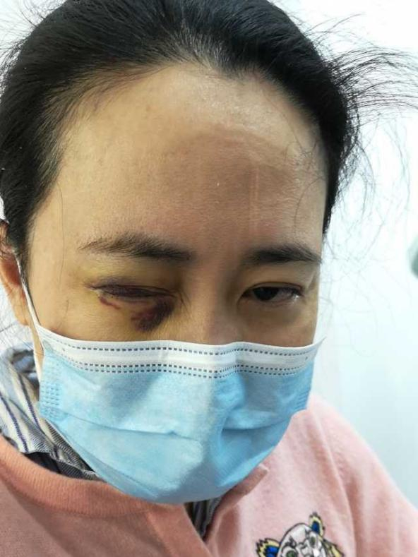 艾芬视网膜脱落后在眼科病房中的照片。受访者供图