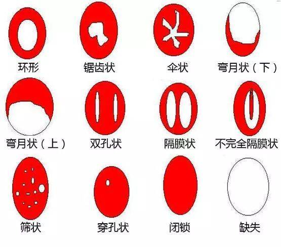 处女膜的和各种形状丨www.menstrual-cycle.info