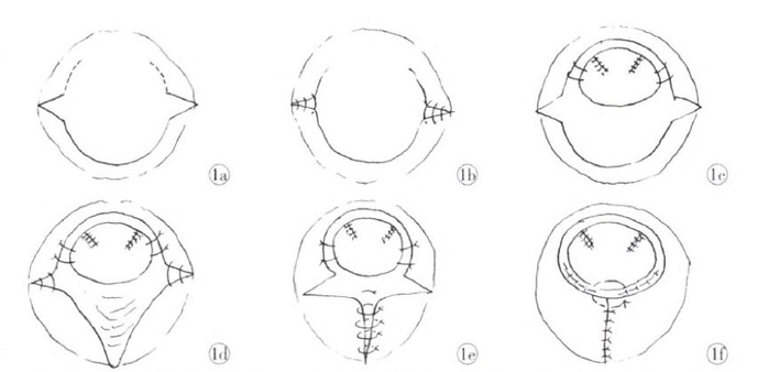 国内文献报道的一部分手术方式|由北京医院医生刘韬滔提供