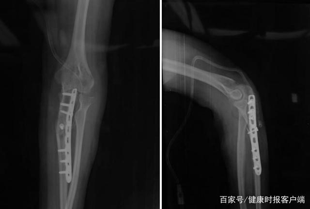 患者手术后肘关节正侧位X线片显示尺骨畸形矫正，内固定位置良好。受访者供图
