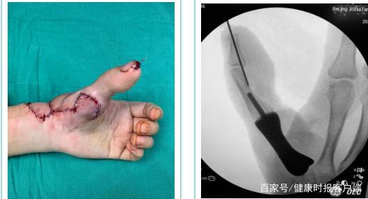 北京积水潭医院采用定制化3D打印技术为患者再造拇指。受访者供图