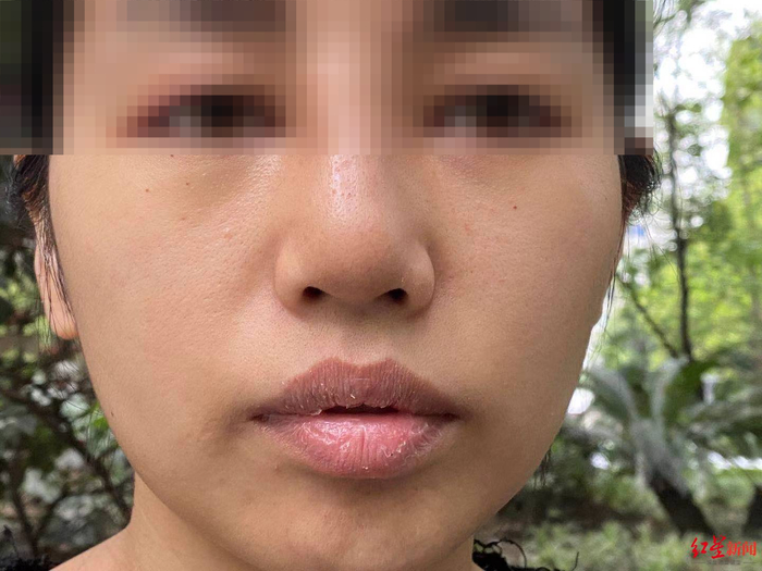 术后鼻子明显肿胀