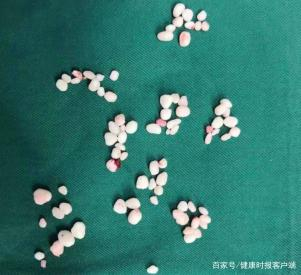 患者体内取出游离体“珍珠”81枚。