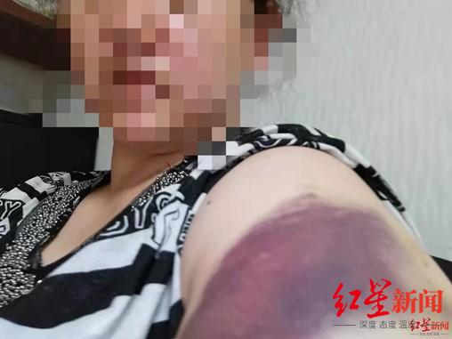 ▲小明妈妈被儿子打伤&nbsp;