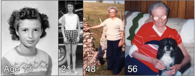 成人早老综合征患者 图片来源：University of Washington