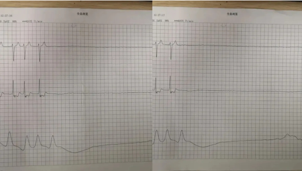 图说：触目惊心的心电图