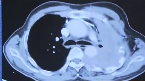 图说：图中右侧为恶性胸膜间皮瘤患者病灶，随着疾病发展，肿瘤会迅速增满肺部