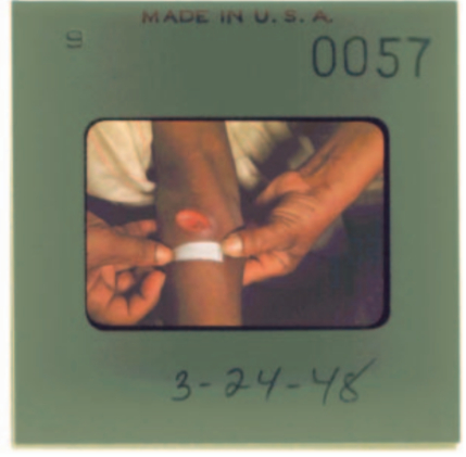 △一名被人工感染梅毒的危地马拉女性精神病患，出现了典型的梅毒下疳。该病患最终在实验中死亡。图片来源：美国总统生物伦理研究委员会2011年9月报告