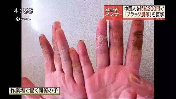 　　日本东京电视台曾经报道过处理紫苏叶的中国籍实习生的情况，由于恶劣的工作和生活条件，双手严重脱皮