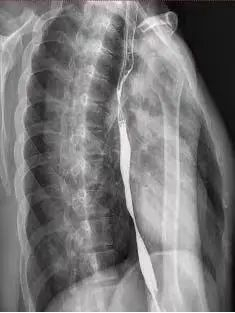 ▲小蔡如今的食管