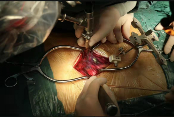 图4 机器人辅助建立椎弓根通道