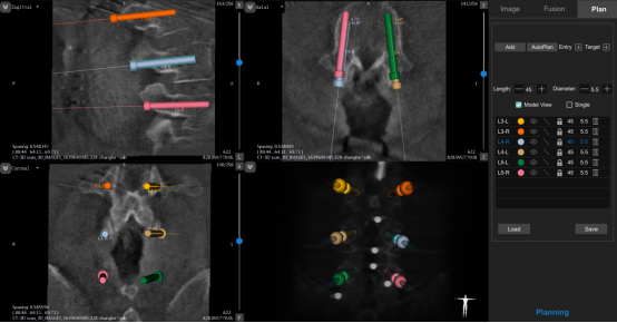 图3 椎弓根螺钉规划示意图