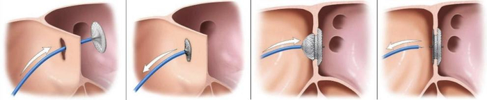 ASD操作步骤示意图——封堵器像一把“伞”封堵住了房间隔缺损