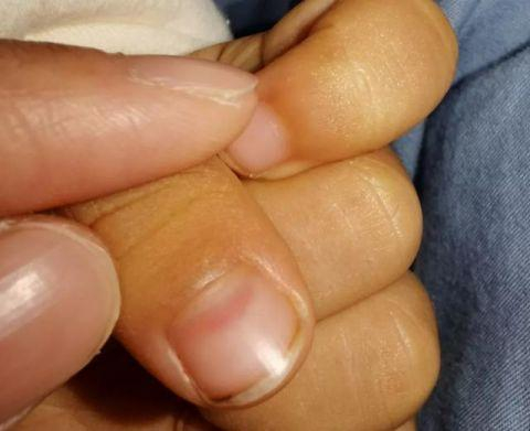 △孩子指甲处被咬后出现淤血情况