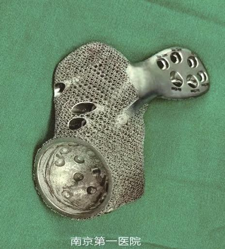  图为为患者植入的3D打印个性化假体。