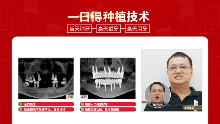 　　*秋哥种牙前后对比