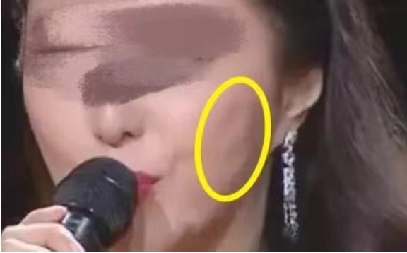 明星在线雕术后出现面部凹陷情况