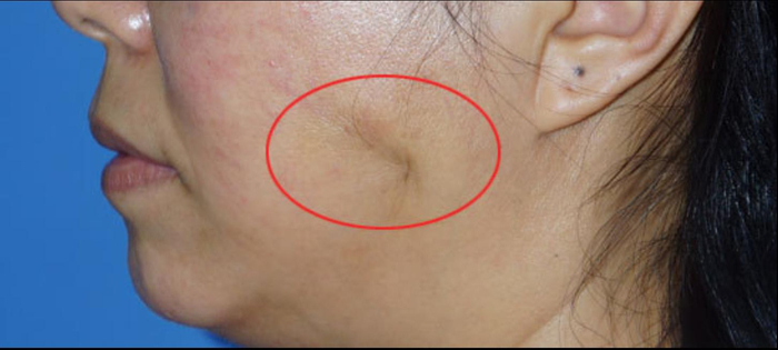  线雕术后面部凹陷示意图 