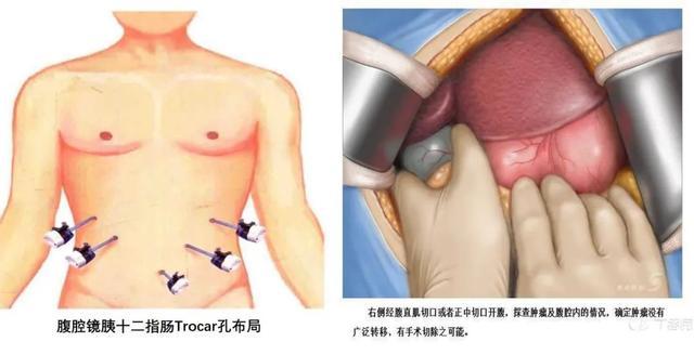 腹腔镜胰十二指肠切除那些事儿_手机新浪网